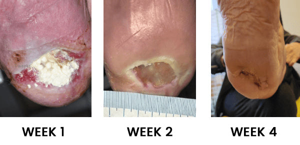 Cvreoz® Advanced Wound Healing Cream for Diabetic Skin 20 t3 b3685814 a161 4b8e a52f 1b57b52759af